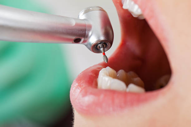 Best Emergency Root Canal Therapy in Kenner, LA